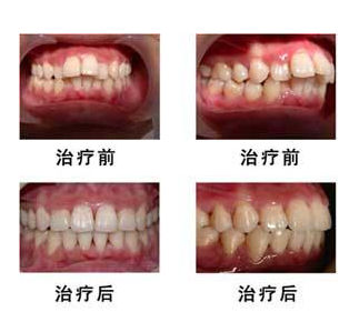 暴牙矫正牙齿的费用是多少